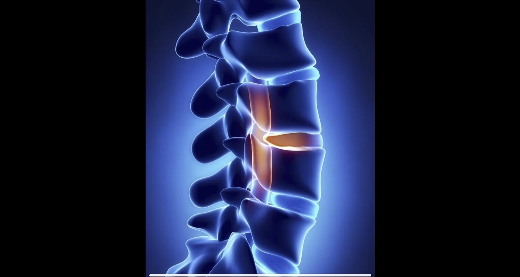 頂都頂不了一下的腰椎間盤突出