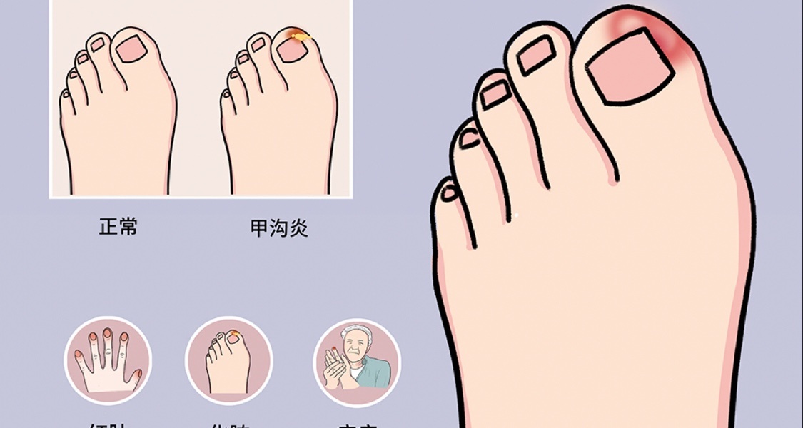 甲溝炎！嵌甲！怎麼處理？