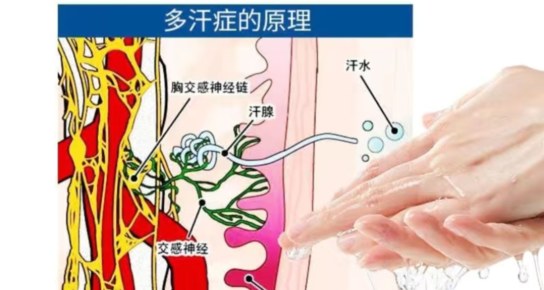 一摸鼠标键盘就打滑？一握手就黏糊糊？带你了解手汗症的背后原因