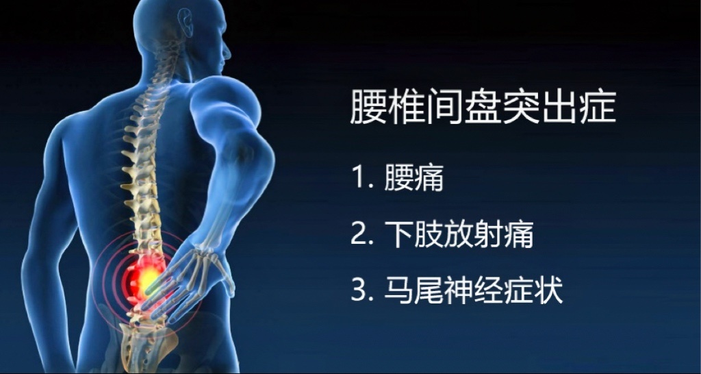 腰椎間盤突出的4個階段，希望你不在其中