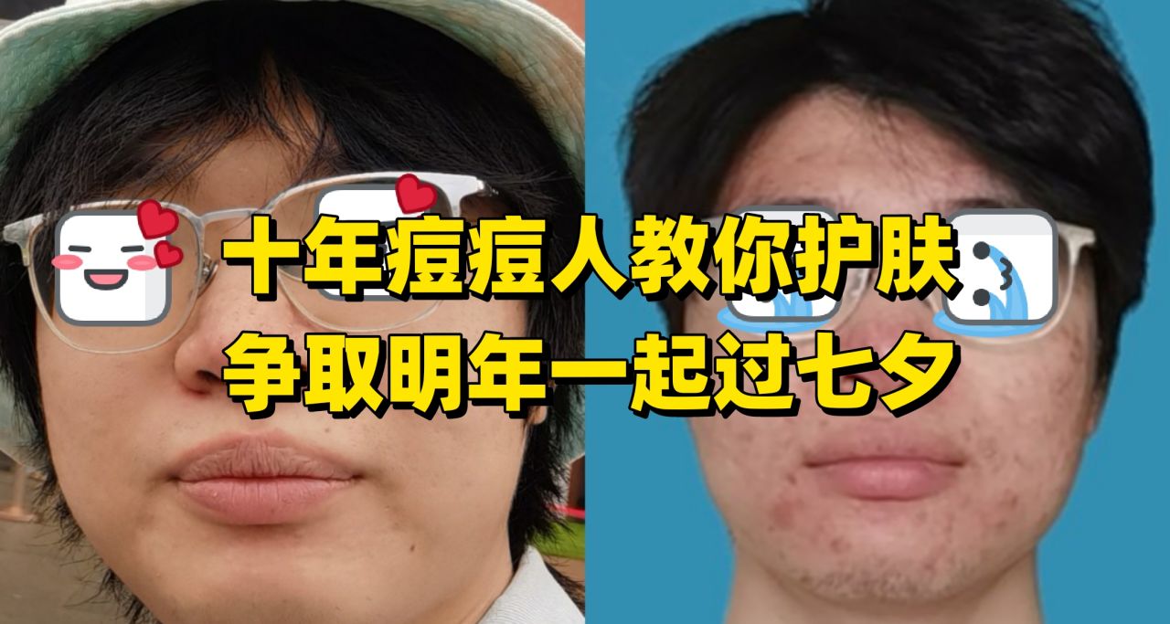 十年痘痘人教你如何護膚