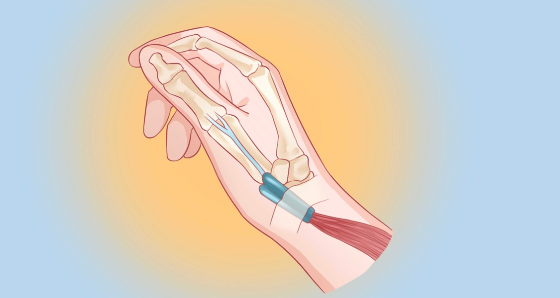 痛痛痛！玩遊戲玩的？淺談腱鞘炎發生和預防。