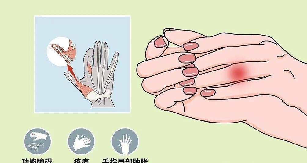 贴扎术4：鼠标手，腱鞘炎，足底筋膜炎的治疗方法
