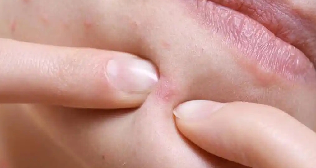 千人收藏普通男生護膚第四彈-不同部位長痘原因