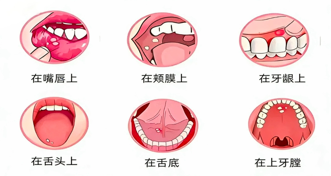 爲啥你總長口腔潰瘍？答案藏在生活裏