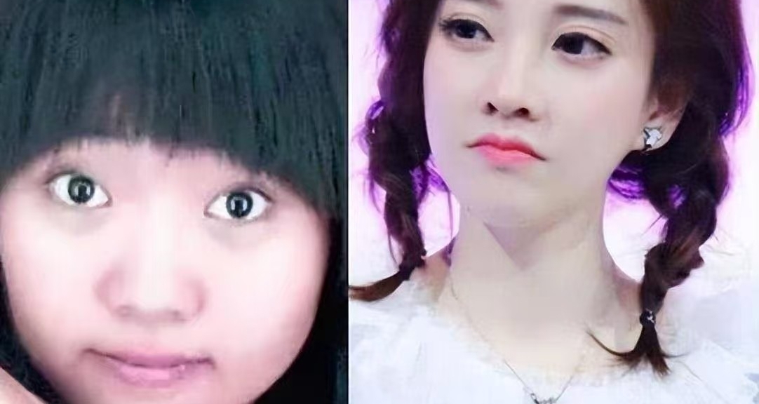 冯提莫直播首度承认整容，自曝双眼皮修复血泪史