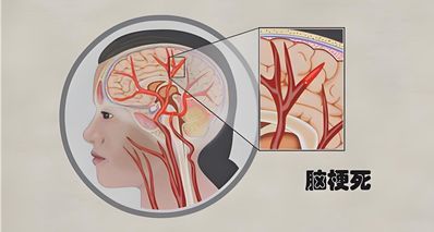身上2處變硬,可能是腦梗前兆