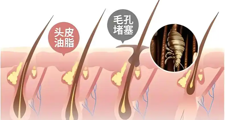 早上洗下午油？拯救“大油頭”指南來啦！