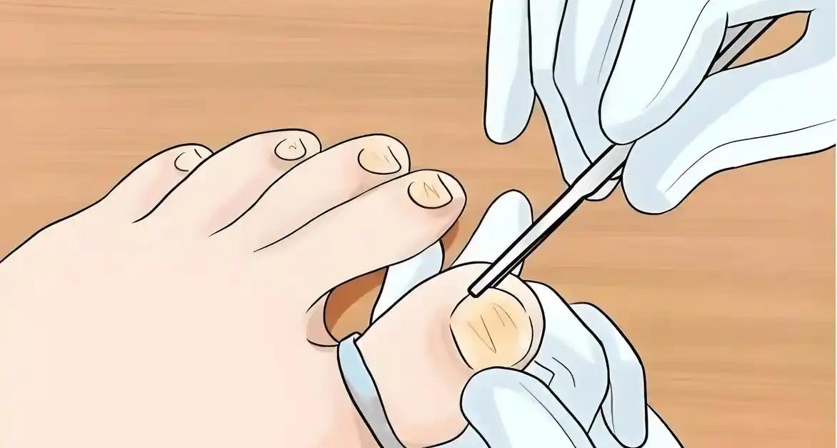 如何預防“甲溝炎”？