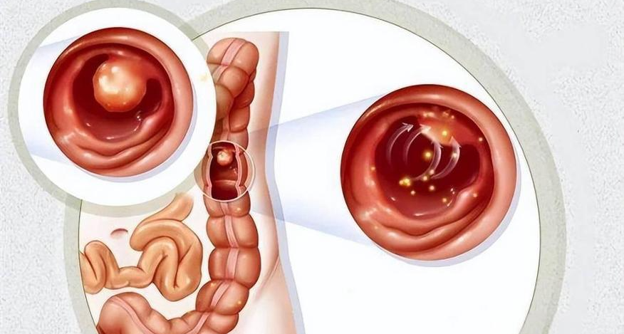 “息肉”是什么？警惕息肉癌变