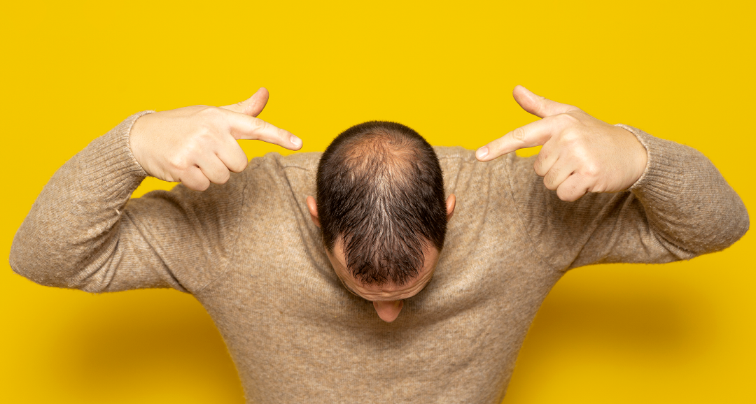 重大利好！脱发人群的福音来了：这种糖可促进头发的强劲再生