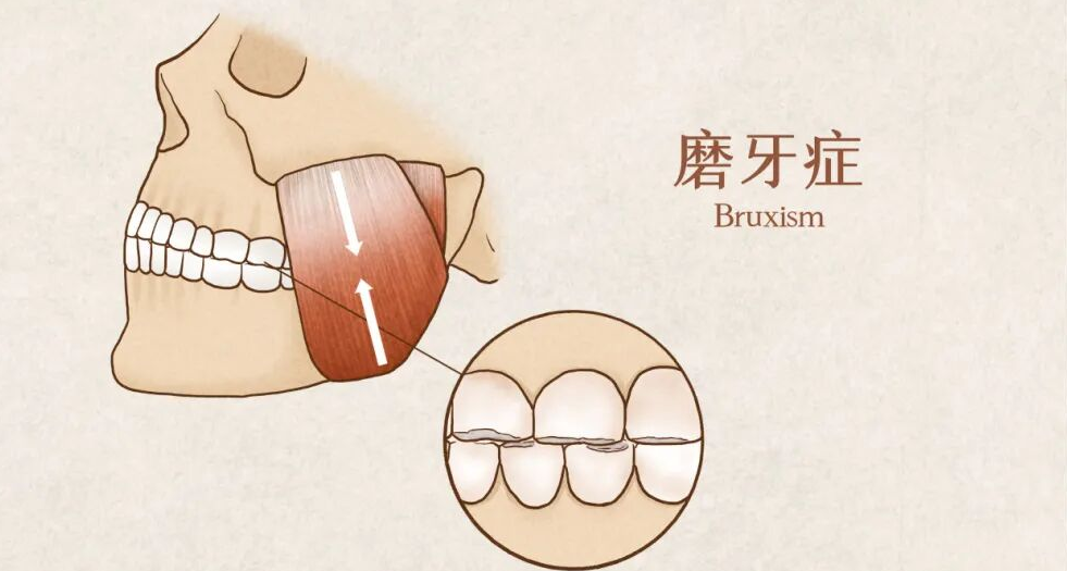 睡觉时嘴里“咯吱”响？为什么有的人会磨牙？