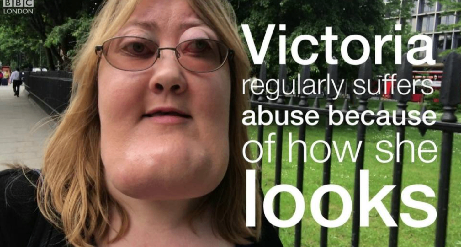 女子因罕見病神似《惡搞之家》角色，多年對抗外貌霸凌終發光