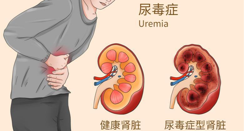 尿毒症正在年輕化？這些習慣、隱患和前兆一定要看懂