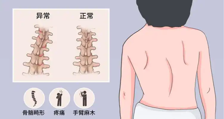 脊柱側彎的危害有多大？哪些行爲會導致脊柱側彎？